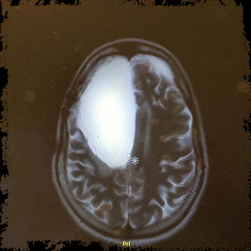 Scanningsbillede af hjernetumor